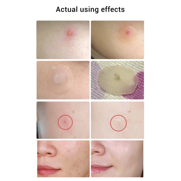 Патчі від акне Lanbena Acne Pimple Patch, 1 упаковка Патчі від акне Lanbena Acne Pimple Patch, 1 упаковка