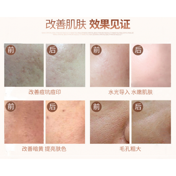 Нано Дермоштамп Micro Nano Dermapen, 1 шт Нано Дермоштамп Micro Nano Dermapen, 1 шт