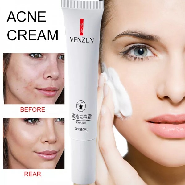 Крем від акне точковий, Venzen Acne Cream, з нікотинамідом, 20 г
