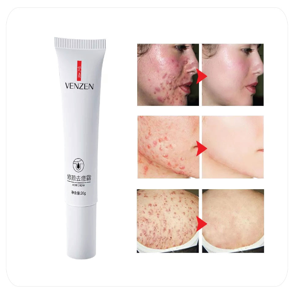 Крем від акне точковий, Venzen Acne Cream, з нікотинамідом, 20 г