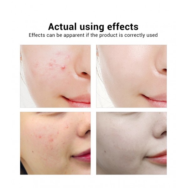 Крем від акне точковий, Venzen Acne Cream, з нікотинамідом, 20 г