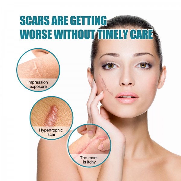 Пластир силіконовий від шрамів та рубців West&Month Silicone Scar Sheets, гель-пластир від шрамів, тілесний, 4 см х 1,5 м
