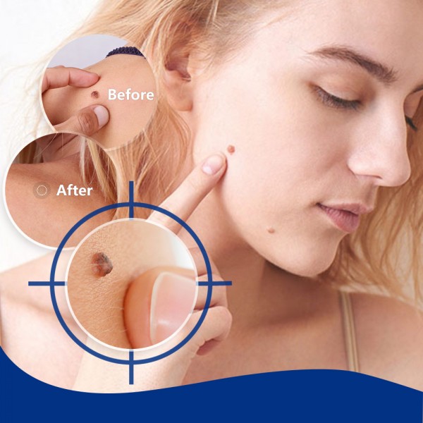 Рідина для видалення бородавок Sumifun Wart Remover, 20 мл