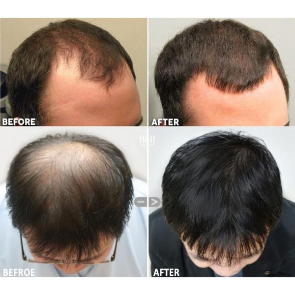 Мезоролер матовий чорний, титанові голки, 540 шт, матовий футляр, 0,5 мм