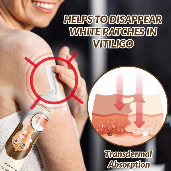 Крем зволожуючий від вітіліго, відновлення пігменту шкіри та зменшення білих плям Vitiligo Removal Cream, 20г
